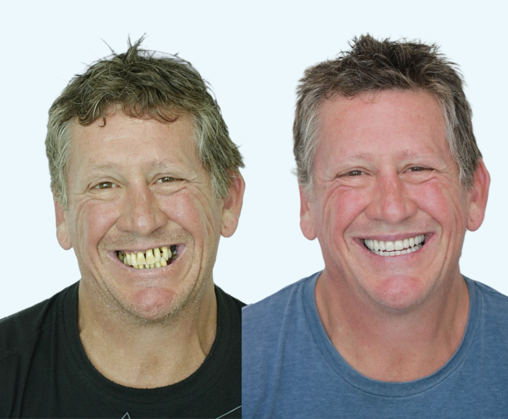 All-on-4-Dental-implants-results-from-Creative-Smiles-1024x844
